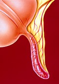 Illustration of an appendix with appendicitis