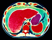 Coloured CT scan showing ascites of the abdomen