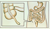 Artwork showing appendicitis
