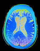 Coloured CT scan of brain with Alzheimer's disease