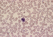 LM of blood smear showing iron-deficiency anaemia