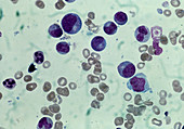 Bone marrow smear showing aplastic anaemia