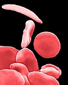SEM of blood in sickle cell anaemia