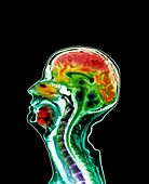 Brain atrophy,MRI scan