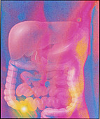 Computer artwork depicting appendicitis
