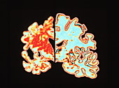 Alzheimer's disease brain vs normal