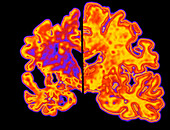 Artwork of Alzheimer's diseased brain vs normal