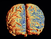 Computer artwork of brain with Alzheimer's disease