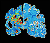 Sectioned brains: Alzheimer's disease vs normal