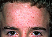 Acne vulgaris on a teenage boy's forehead
