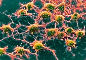 Coloured SEM of Alzheimer's disease culture cells
