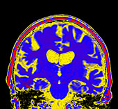 Alzheimer's disease MRI