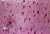 Alzheimer's disease brain tissue