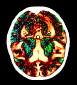 Alzheimer's disease brain,CT scan