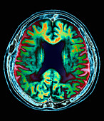 Alzheimer's disease,MRI