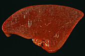 Amyloidosis of the spleen