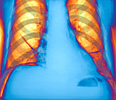 Collapsed lung,X-ray