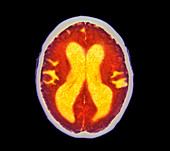 Alzheimer's disease brain,coloured CT scan