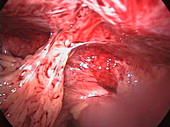 Abdominal adhesion