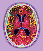 Alzheimer's disease,MRI scan