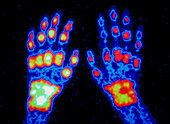 False-colour scintigram of arthritic hands