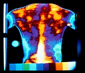 Thermogram of a man's rheumatic back