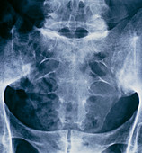 X-ray of pelvis and sacral spine