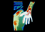 Thermogram showing rheumatoid arthritis in hand