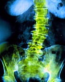 False-col X-ray of lumbar spine of woman aged 80