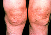 Rheumatoid arthritis in knees