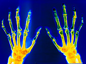 X-ray of hand showing rheumatoid arthritis