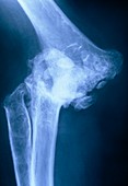 Tinted X-ray of elbow with rheumatoid arthritis