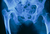 F/col X-ray of osteoarthritis in pelvis