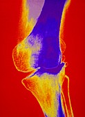 F/col X-ray of arthritic knee joint