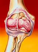 Illustration of arthritis in elbow joint