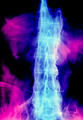Spinal x-ray ankylosing spondylitis
