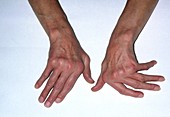 Deformed hands due to rheumatoid arthritis