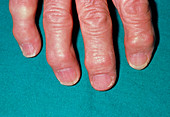 Arthritic hand showing Heberden's nodes on fingers