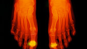 False-colour X-ray of feet: rheumatoid arthritis