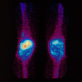 F/col gamma scan of a knee affected by arthritis