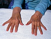 Elderly ladies arthritic hands spread out