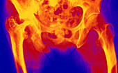 Coloured X-ray of osteoarthritis of the hip