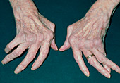 Woman's hands crippled with rheumatoid arthritis