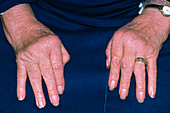 Rheumatoid arthritis of hands with ulnar deviation
