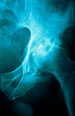 X-ray of osteoarthritis of the hip