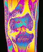 Colour MRI scan of knee joint with osteoarthritis