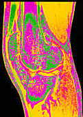 Colour MRI scan of knee joint with osteoarthritis
