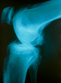 X-ray view of knee joint with osteoarthritis