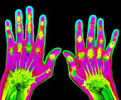 Coloured X-ray of hands with rheumatoid a