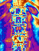 Coloured X-ray of spine in ankylosing spondylitis